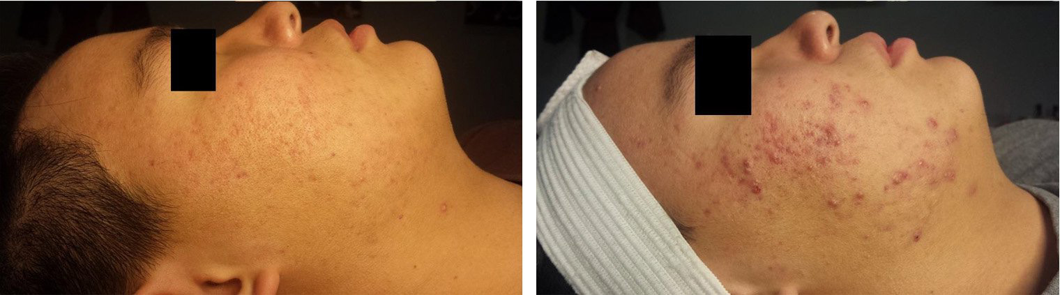 acne-treatment-1-2